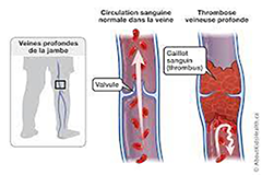 thrombose jambe